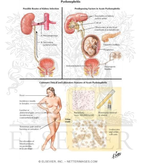 Watermarked preview of labeled image: Pyelonephritis
