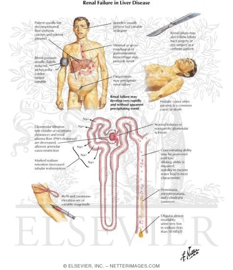 Renal Failure in Liver Disease