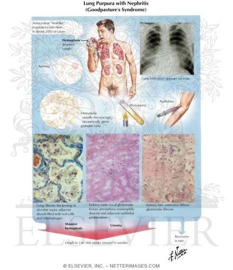 Watermarked preview of labeled image: Lung Purpura With Nephritis (Goodpasture's Syndrome)