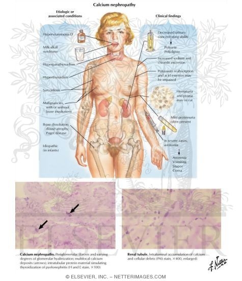 Calcium Nephropathy