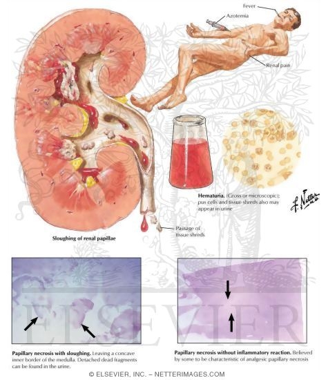 Watermarked preview of labeled image: Necrotizing Papillitis