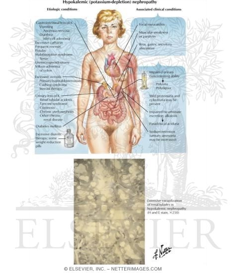 Watermarked preview of labeled image: Potassium Depletion Nephropathy