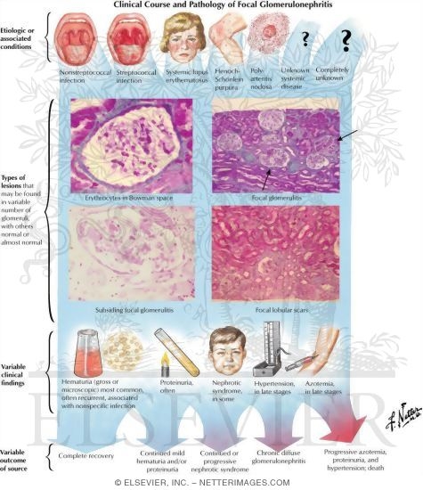 Watermarked preview of labeled image: Focal Glomerulonephritis