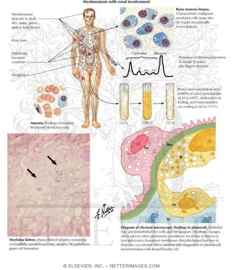 Watermarked preview of labeled image: Myelomatosis with Renal Involvement
