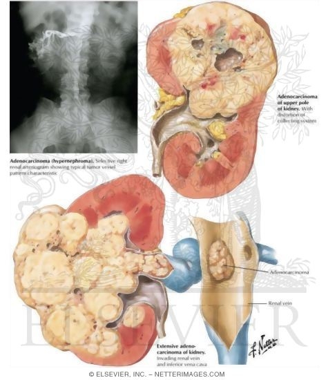 Watermarked preview of labeled image: Malignant Tumors of the Kidney