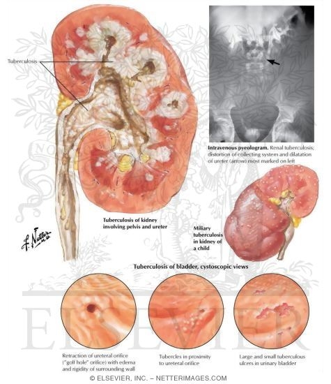 Tuberculosis of the Urinary Tract