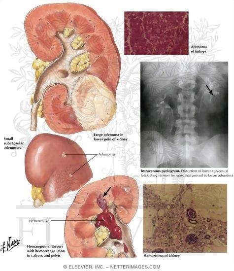 Watermarked preview of labeled image: Benign Tumors of the Kidneys