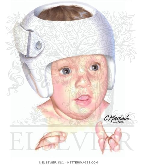 Watermarked preview of unlabeled image: Deformational Plagiocephaly