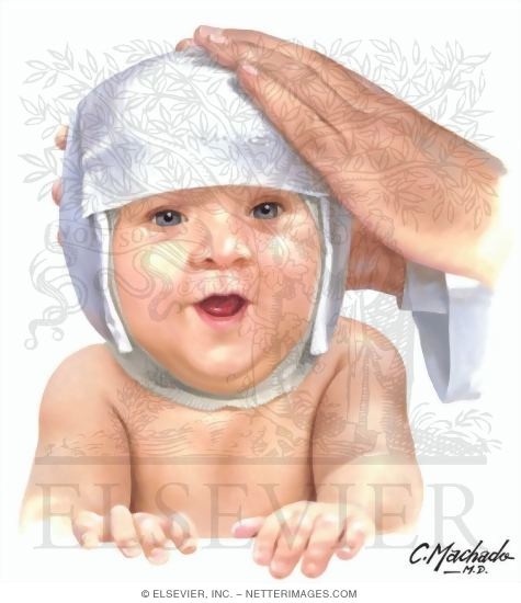 Watermarked preview of unlabeled image: Plagiocephaly: Molding the Orthotic