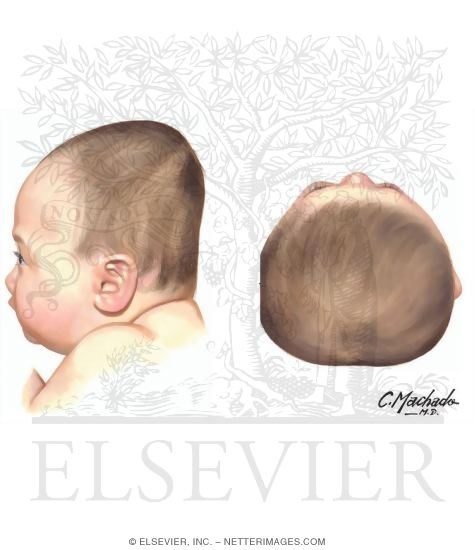 Watermarked preview of unlabeled image: Brachycephaly