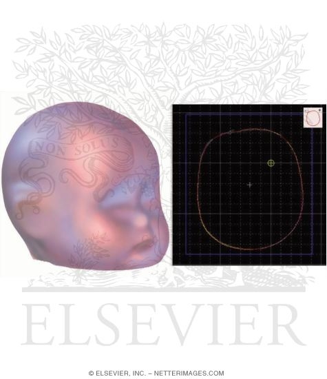 Watermarked preview of unlabeled image: Plagiocephaly: Scanning for Orthotic Mold
