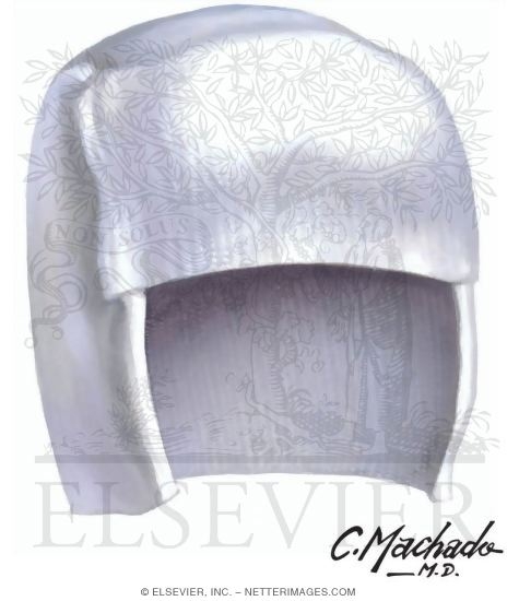 Watermarked preview of unlabeled image: Plagiocephaly: Orthotic Mold