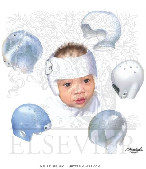 Watermarked preview of unlabeled image: Plagiocephaly: Cranial Remolding Orthoses