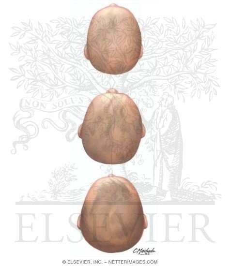 Plagiocephaly