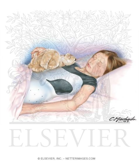 Watermarked preview of unlabeled image: Scoliosis: Sleeping With Orthosis