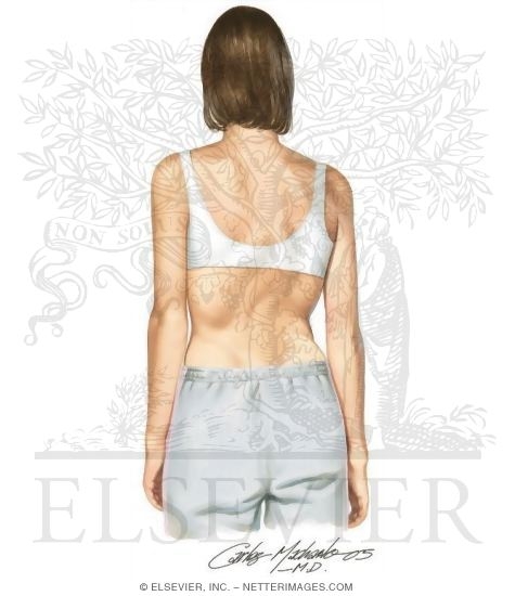 Watermarked preview of unlabeled image: Scoliosis: What You Might Notice