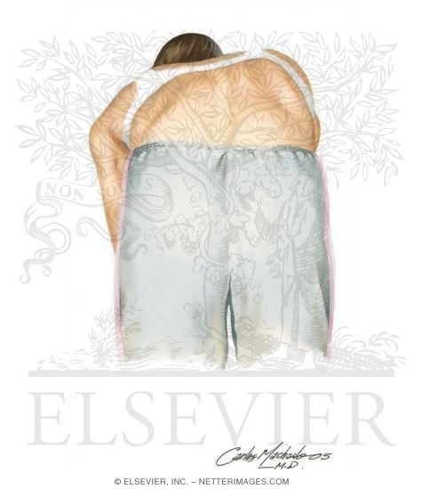 Watermarked preview of unlabeled image: Scoliosis: What You Might Notice