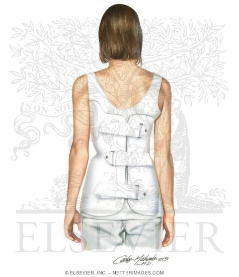 Watermarked preview of unlabeled image: Scoliosis: How An Orthosis Works