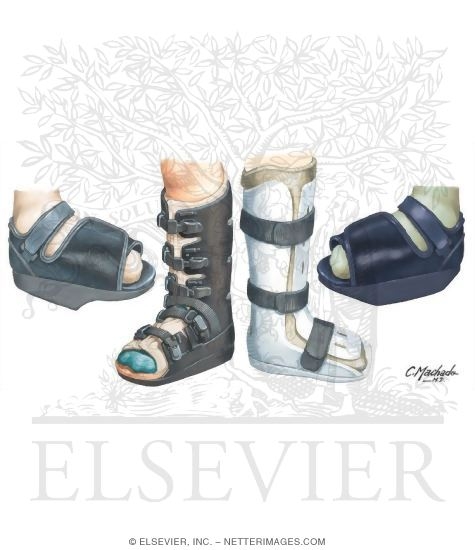 Walking Cast