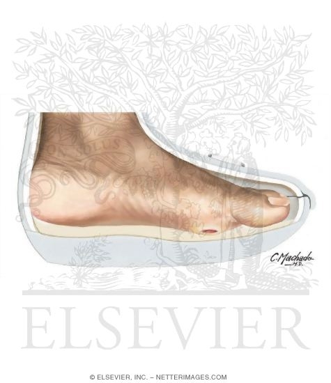 Watermarked preview of unlabeled image: Neuropathic Walker