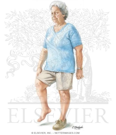 Diabetic Neuropathy and Drop Foot