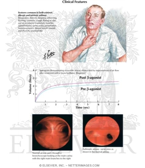 Watermarked preview of labeled image: Clinical Features of Asthma