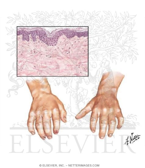 Watermarked preview of unlabeled image: Progressive Systemic Sclerosis (Scleroderma)