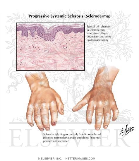 Progressive Systemic Sclerosis (Scleroderma)