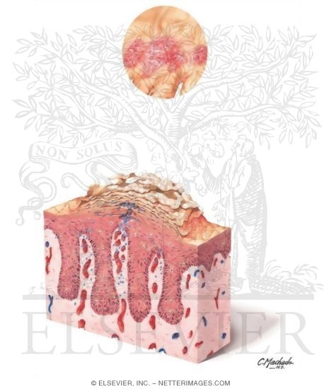 Watermarked preview of unlabeled image: Plaque Psoriasis