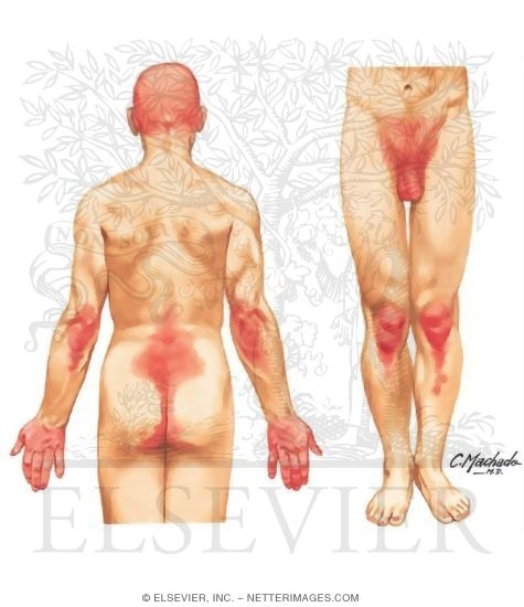 Watermarked preview of unlabeled image: Psoriasis