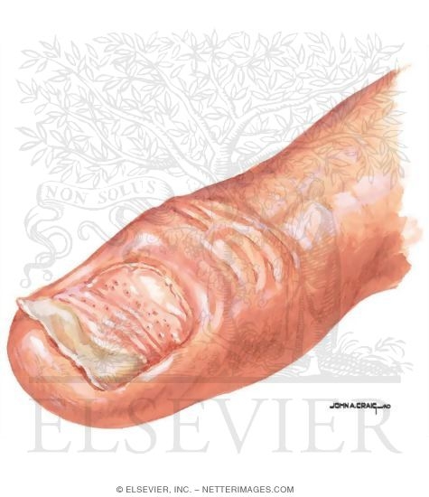 Watermarked preview of unlabeled image: Psoriatic Nail Involvement