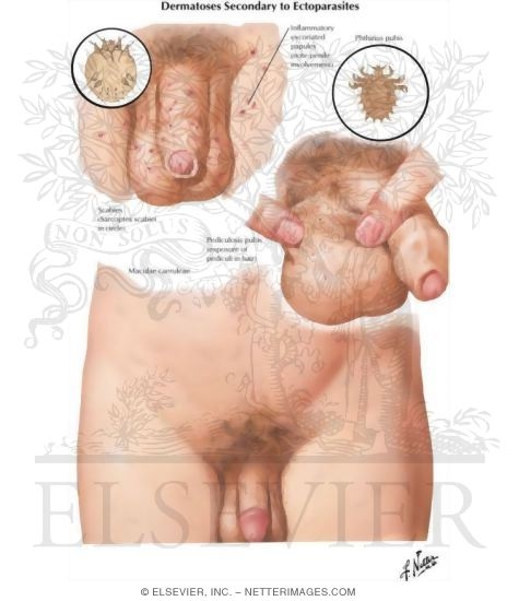 Watermarked preview of labeled image: Dermatoses II - Arthropodic Origin