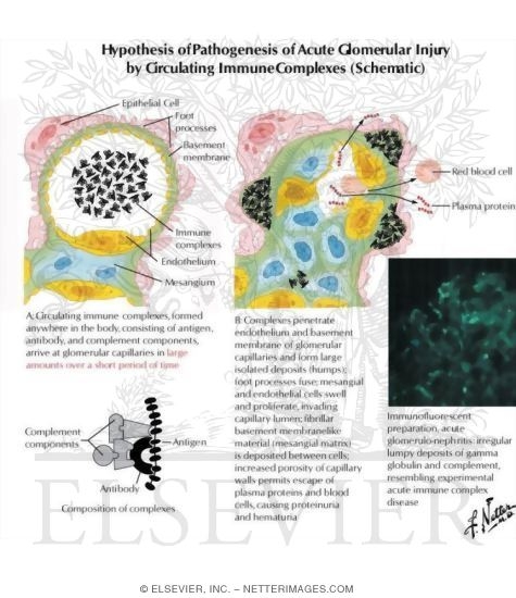 Watermarked preview of labeled image: Hypothesis of Pathogenesis of Acute Glomerular Injury By Circulating Immune Complexes (Schematic)