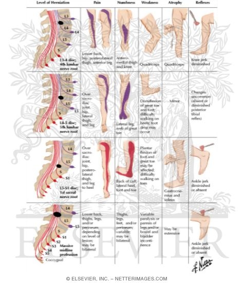Herniated Nucleus Pulposus (Lumbar); Clinical Features