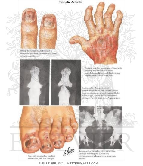 Watermarked preview of labeled image: Psoriatic Arthritis