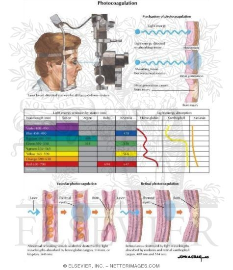 Watermarked preview of labeled image: Photocoagulation