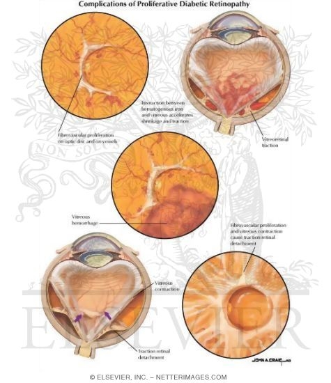 Complications of Proliferative Diabetic Retinopathy