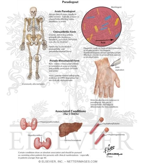 Watermarked preview of labeled image: Pseudogout