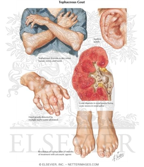 Watermarked preview of labeled image: Tophaceous Gout
Gouty Arthritis