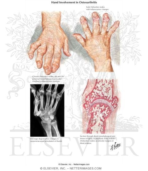 Watermarked preview of labeled image: Hand Involvement In Osteoarthritis
