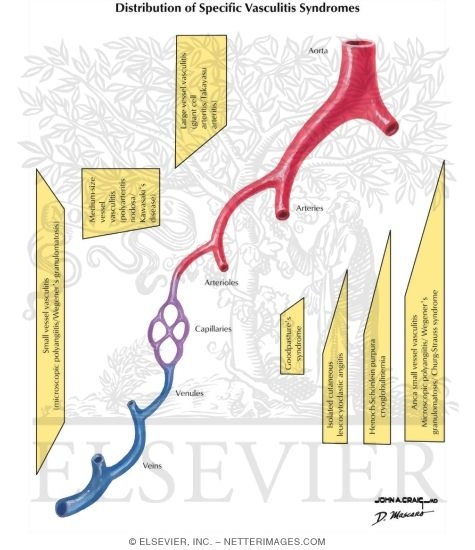 Distribution of Specific Vasculitis Syndromes