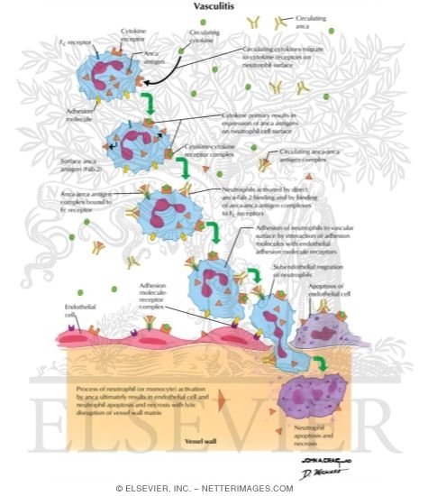 Watermarked preview of labeled image: Vasculitis