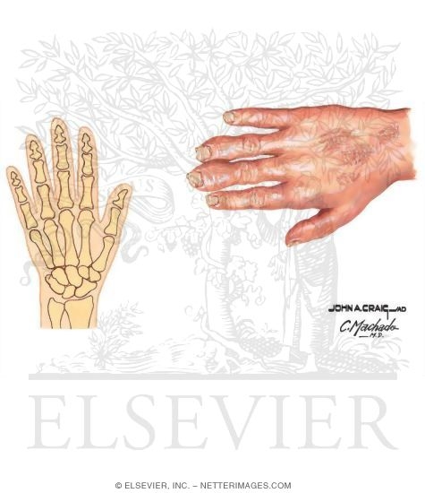 Watermarked preview of unlabeled image: Psoriatic Arthritis