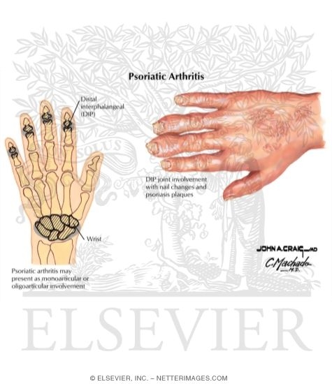 Watermarked preview of labeled image: Psoriatic Arthritis