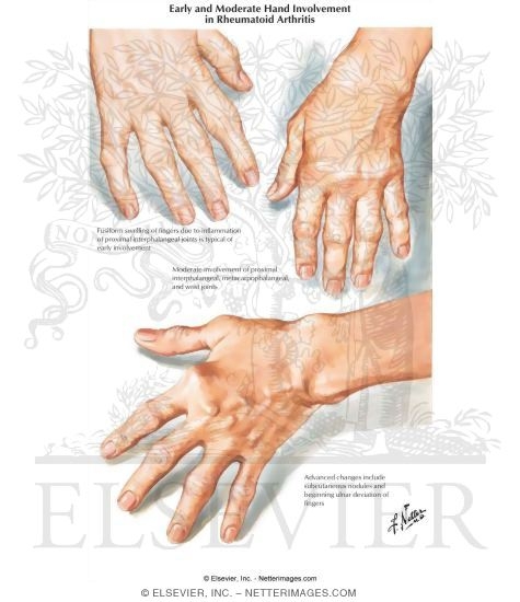 Watermarked preview of labeled image: Early and Moderate Hand Involvement In Rheumatoid Arthritis
