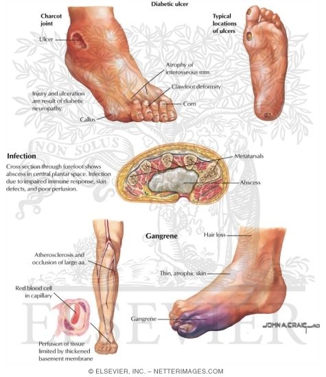 Lesions in Diabetic Foot