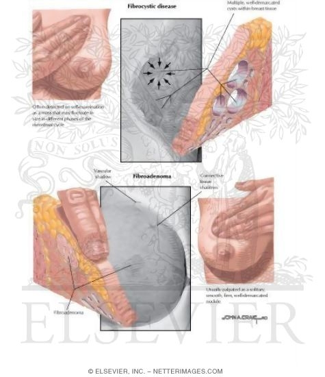 Watermarked preview of labeled image: Fibrocystic Disease 