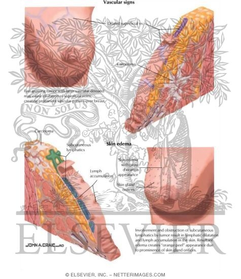 Watermarked preview of labeled image: Clinical Signs of Cancer