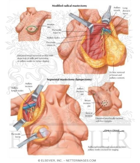 Watermarked preview of labeled image: Surgical Management of Breast Cancer