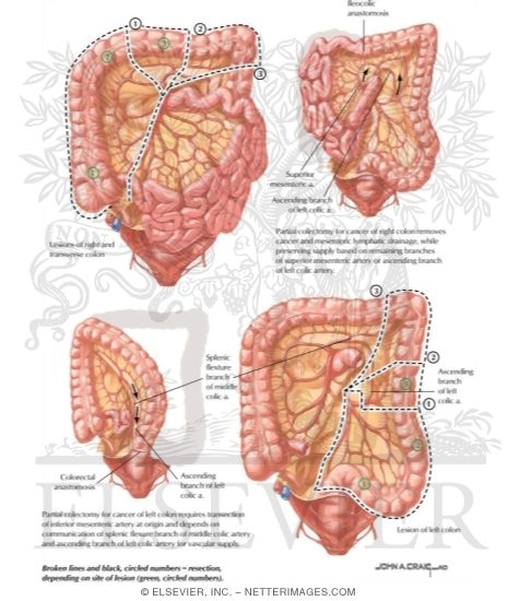 Watermarked preview of labeled image: Surgical Resection of Colon Cancer